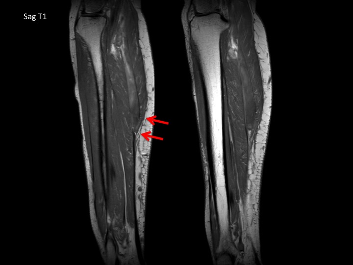 Figure 2 for case medial head of gastrocnemius muscle ( RID2921 )